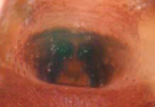 Gonatium rubens - epigynum (c) Ratering